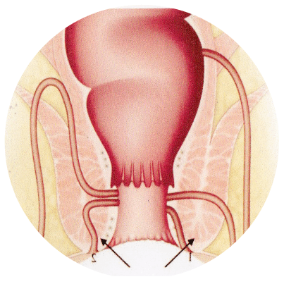 fistula